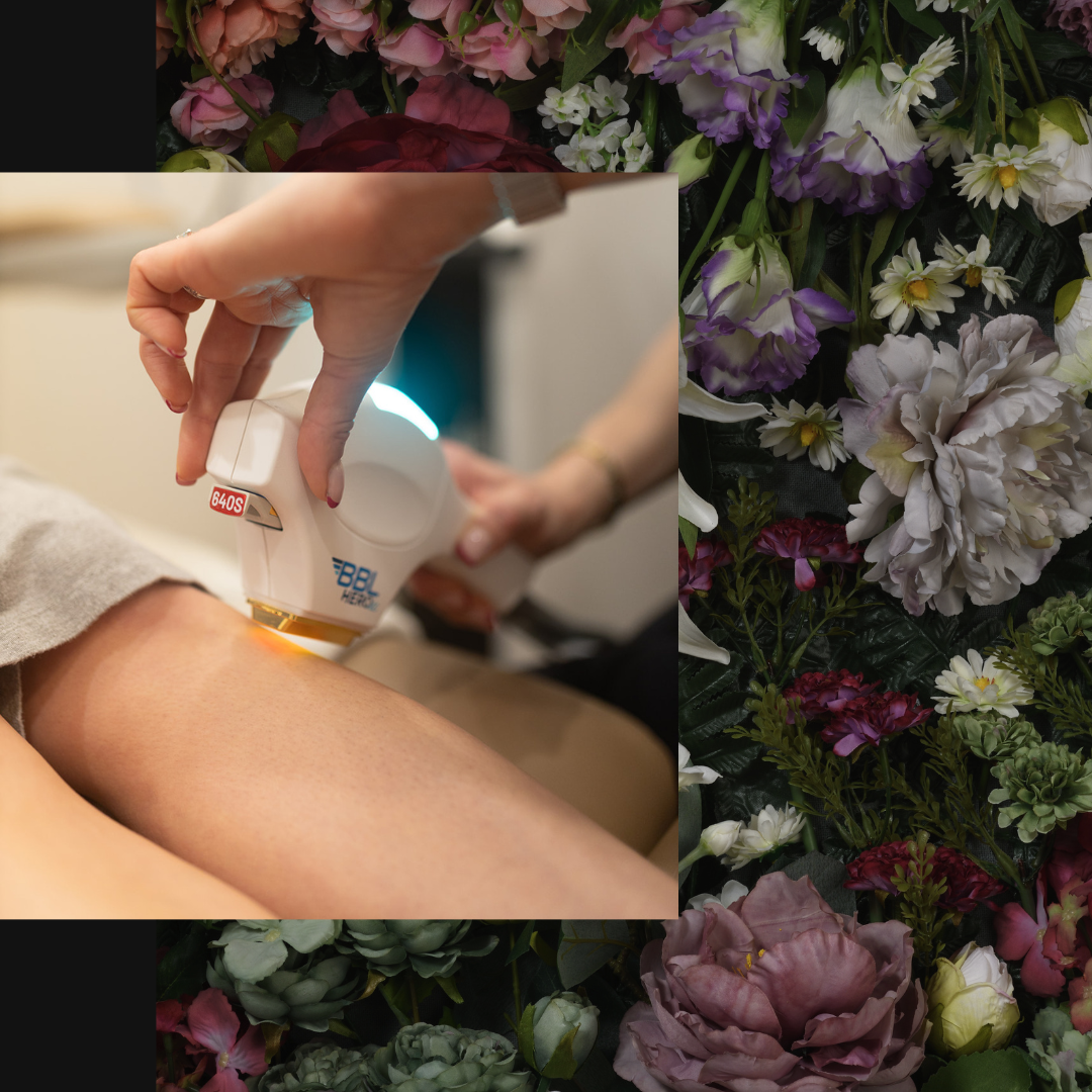 Non-surgical stretch mark treatments