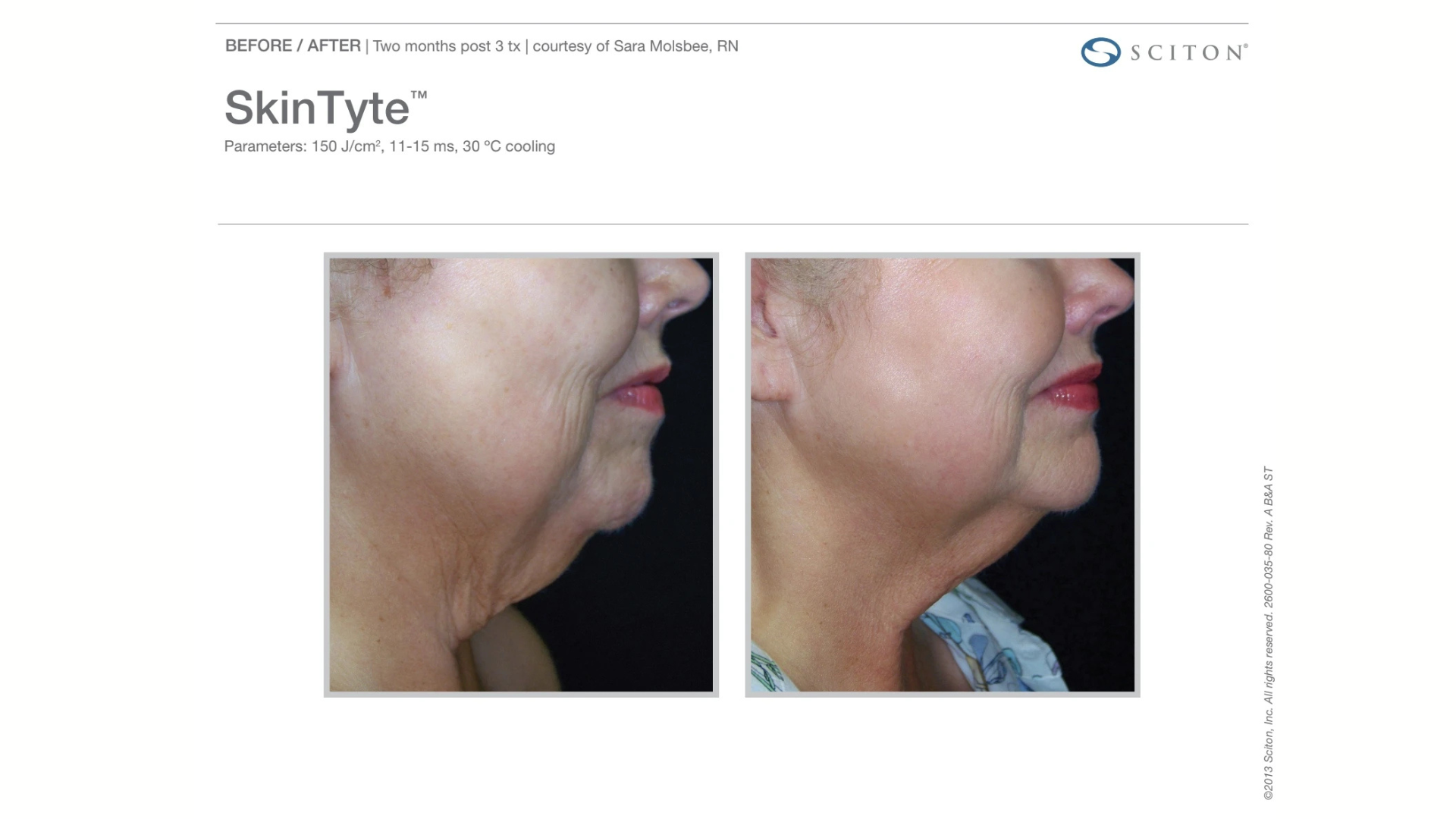 sciton skintyte treatment