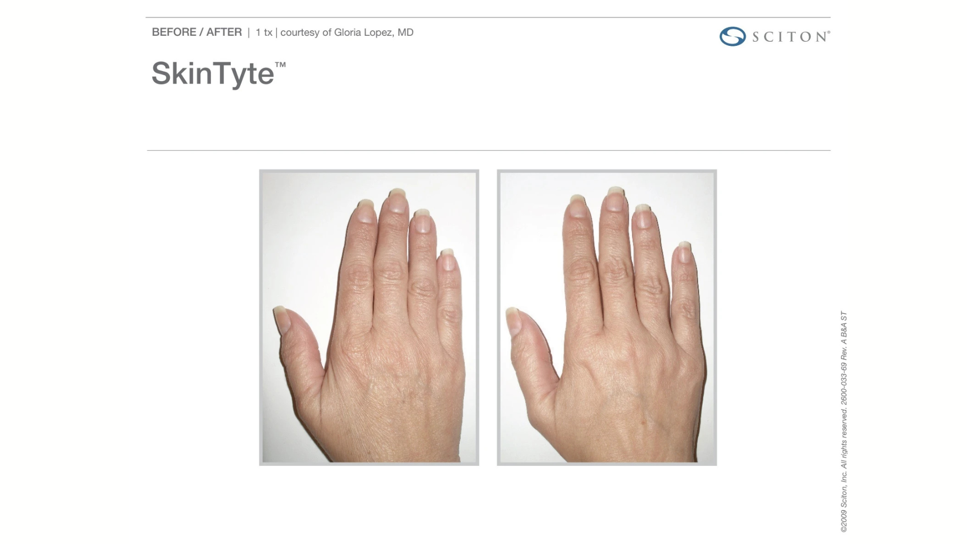 sciton skintyte treatment