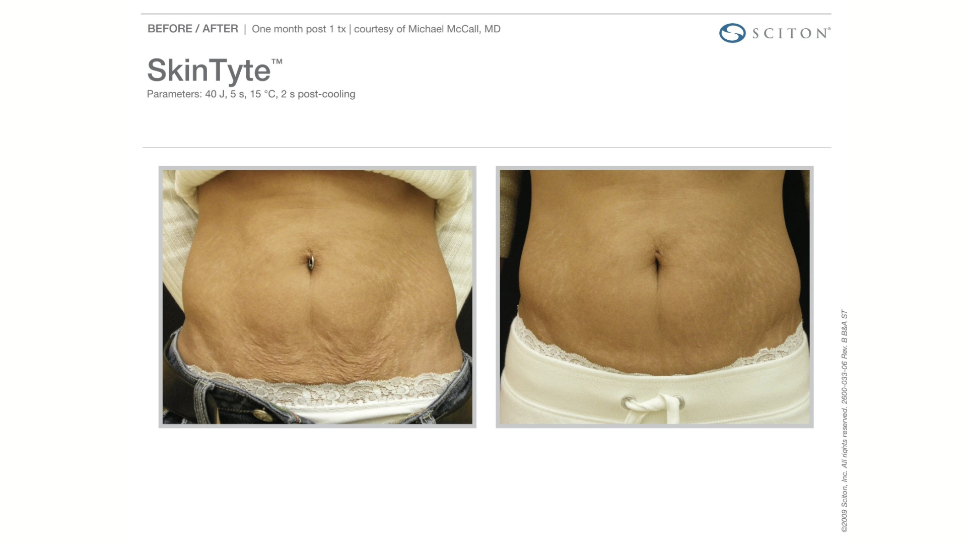 sciton skintyte treatment