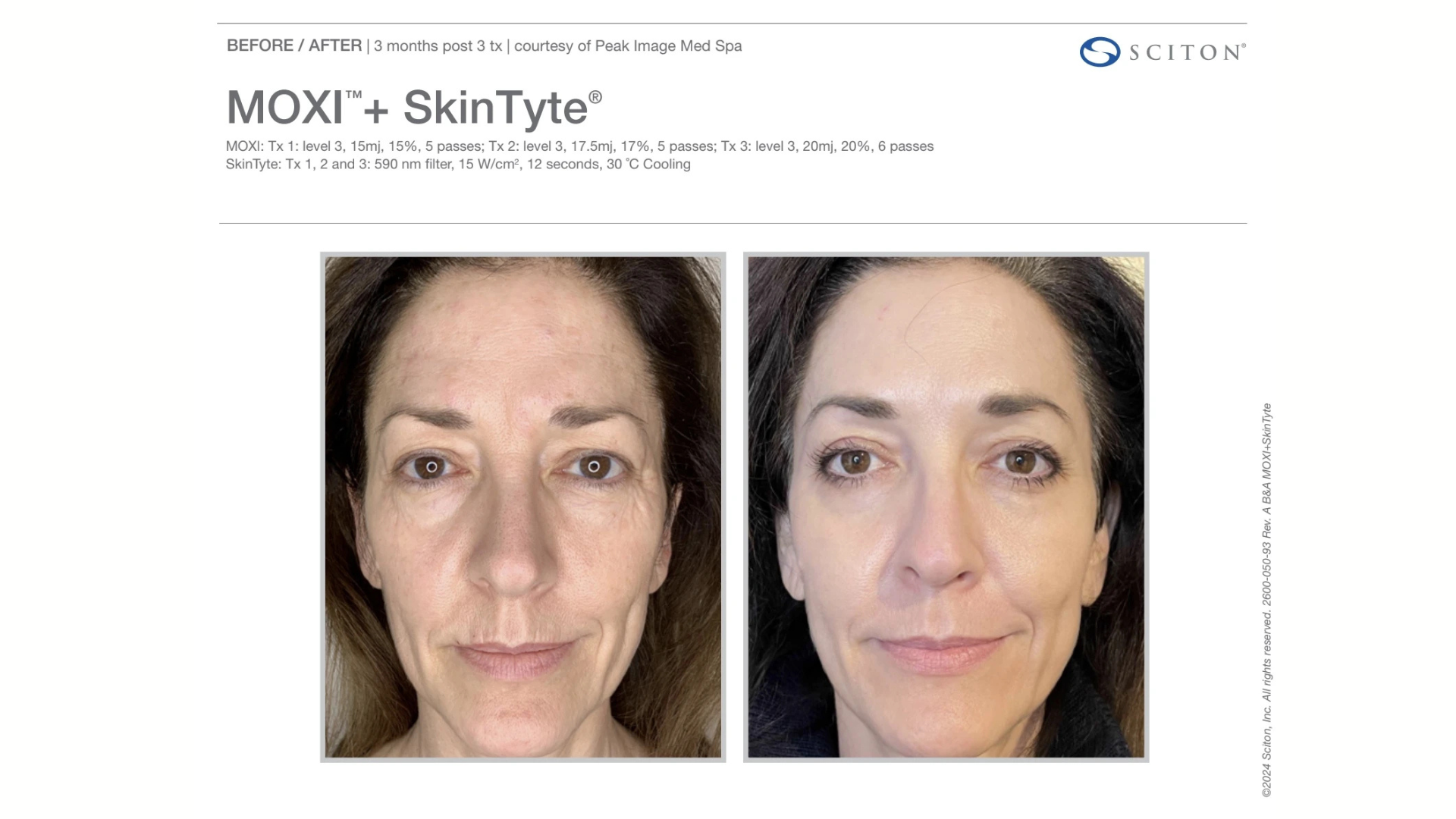 sciton skintyte treatment